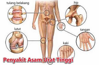 Illustration for article titled Obat Asam Urat Herbal